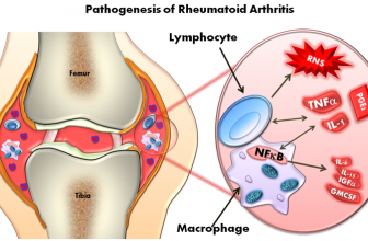 9 remedii pentru artrite reumatoide